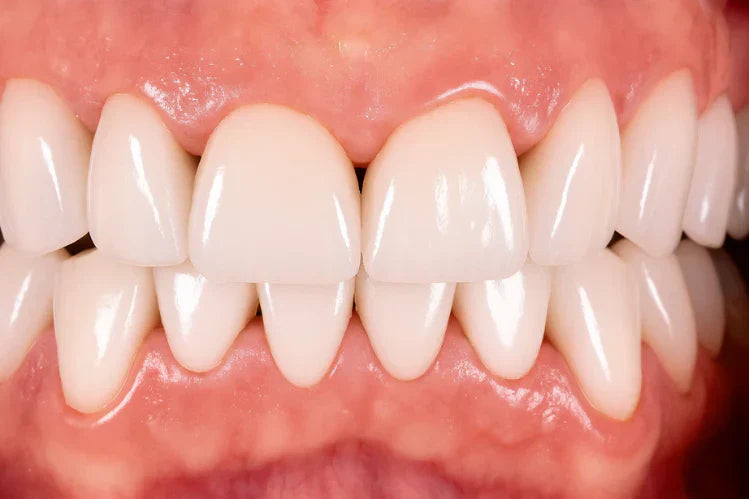 Uma imagem aproximada de como são os triângulos pretos entre os dentes.