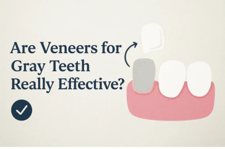 Ilustração que mostra um dente acinzentado a ser coberto com uma faceta dentária.