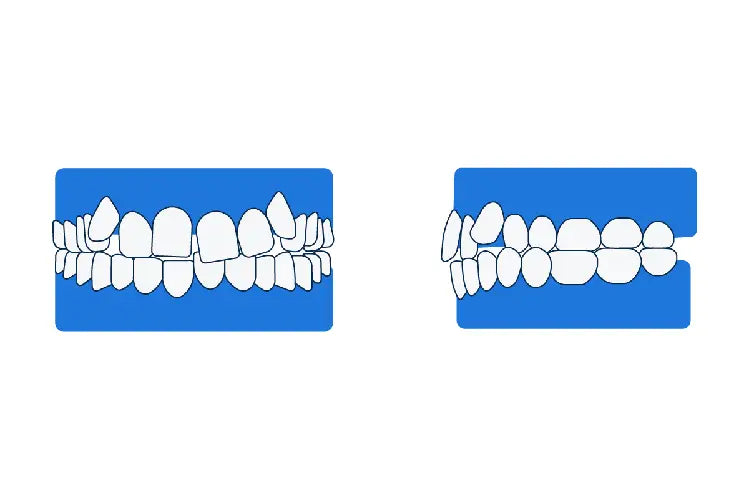 Uma ilustração de dentes tortos