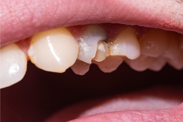 Dente lascado: causas, sintomas e reparação