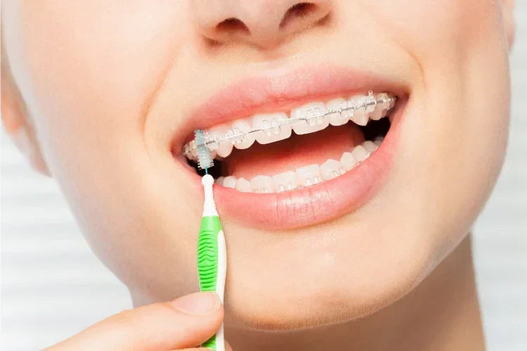 Uma menina usa uma escova interdental de cerdas macias para limpar aparelho de cerâmica