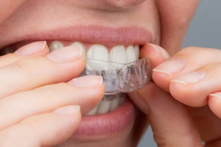 Uma menina aplicando alinhadores transparentes para corrigir os dentes em casa.
