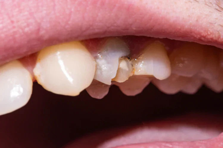 Imagem de um dente morto com o verniz lascado.