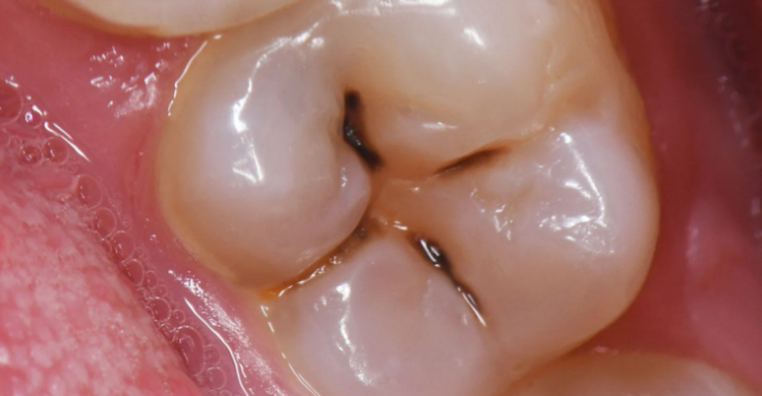 Imagem de um dente com cárie