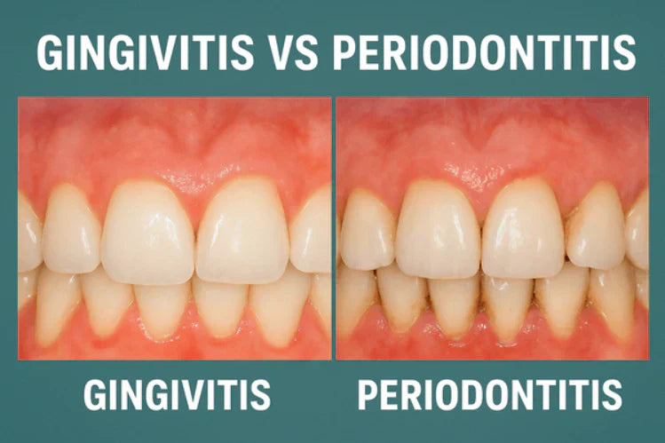 Comparação lado a lado da gengivite e da periodontite
