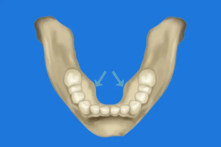 Torus Mandibular: Compreender as Protuberâncias Ósseas na Boca