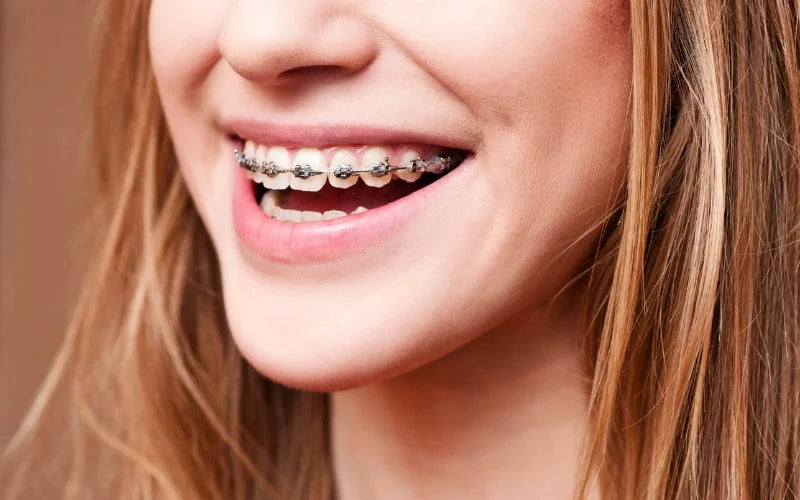 Uma menina sorrindo com aparelho metálico