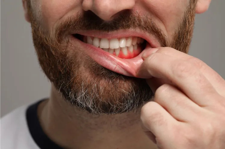 Um homem a mostrar as gengivas inflamadas.