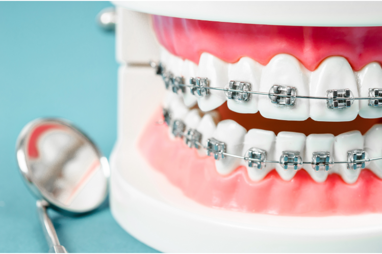  modello di dente con apparecchio dentale in filo metallico e uno specchio dentale sul lato