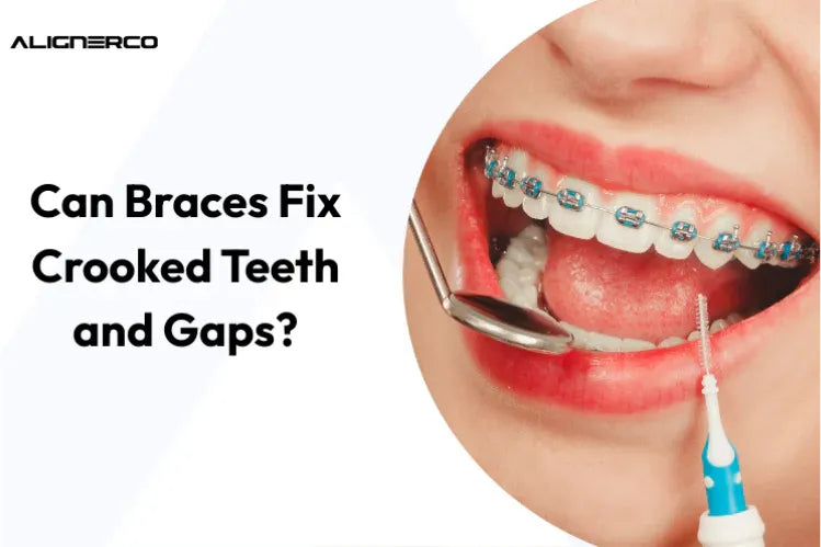 Uma menina usando aparelho ortodôntico metálico colorido para alinhar os dentes.