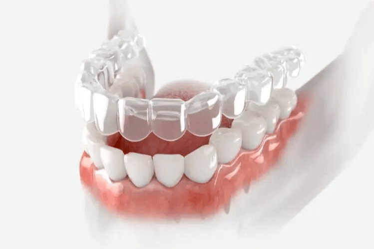 retentores transparentes para alisar os dentes