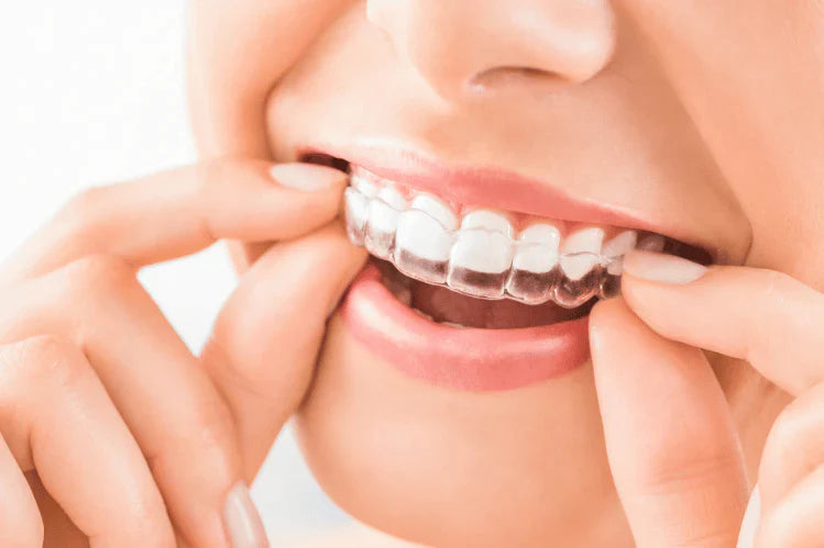 A case study of deep bite and increased over jet & flared upper anteriors correction using ALIGNERCO Clear Aligners