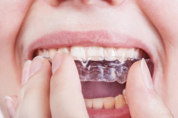 Treatment of retroclined upper anteriors correction using ALIGNERCO Clear Aligners